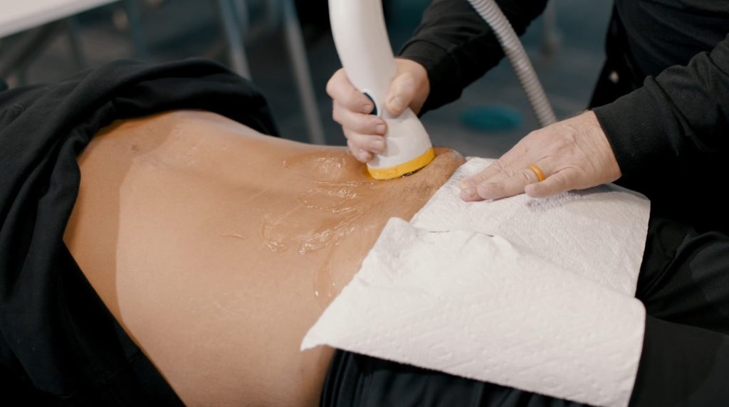 SoftWave Therapy on lower back.
